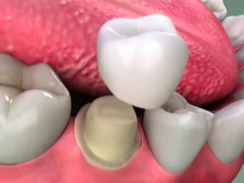 răng tạm được phủ l&ecirc;n c&ugrave;i răng sau khi m&agrave;i của bệnh nh&acirc;n
